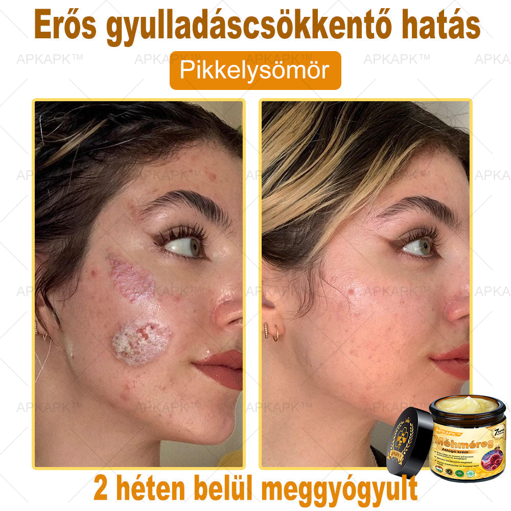 𝐀𝐏𝐊𝐀𝐏𝐊® 𝐌É𝐇𝐌É𝐑𝐄𝐆 Á𝐓𝐅𝐎𝐆Ó 𝐊𝐑É𝐌🥇𝐀 𝐛ö𝐫𝐩𝐫𝐨𝐛𝐥é𝐦á𝐤 𝐤𝐞𝐳𝐞𝐥é𝐬𝐞 𝐦𝐚𝐠á𝐛𝐚𝐧 𝐟𝐨𝐠𝐥𝐚𝐥𝐣𝐚: é𝐥𝐞𝐭𝐤𝐨𝐫𝐢 𝐟𝐨𝐥𝐭𝐨𝐤, 𝐡𝐞𝐠𝐞𝐤, 𝐬𝐳𝐞𝐦ö𝐥𝐜𝐬ö𝐤, 𝐛ö𝐫𝐧ö𝐯𝐞𝐝é𝐤𝐞𝐤, 𝐭á𝐥𝐲𝐨𝐠𝐨𝐤, 𝐩𝐚𝐭𝐭𝐚𝐧á𝐬𝐨𝐤, 𝐞𝐤𝐜é𝐦𝐚, 𝐩𝐬𝐨𝐫𝐢𝐚𝐬𝐢𝐬, 𝐚𝐜𝐧𝐞 𝐢𝐧𝐯𝐞𝐫𝐬𝐚, 𝐫á𝐧𝐜𝐨𝐤, 𝐛ö𝐫ö𝐫𝐞𝐠𝐞𝐝é𝐬 é𝐬 𝐞𝐠𝐲é𝐛 𝐩𝐫𝐨𝐛𝐥é𝐦á𝐤🔥