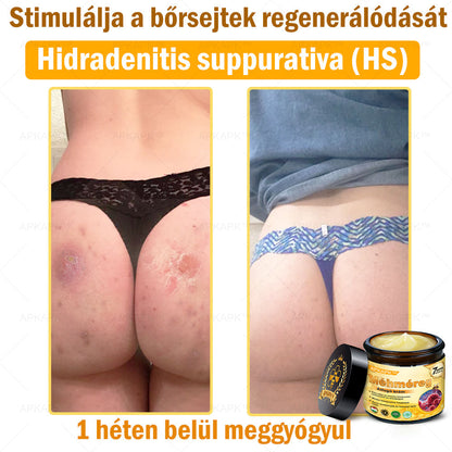 𝐀𝐏𝐊𝐀𝐏𝐊® 𝐌É𝐇𝐌É𝐑𝐄𝐆 Á𝐓𝐅𝐎𝐆Ó 𝐊𝐑É𝐌🥇𝐀 𝐛ö𝐫𝐩𝐫𝐨𝐛𝐥é𝐦á𝐤 𝐤𝐞𝐳𝐞𝐥é𝐬𝐞 𝐦𝐚𝐠á𝐛𝐚𝐧 𝐟𝐨𝐠𝐥𝐚𝐥𝐣𝐚: é𝐥𝐞𝐭𝐤𝐨𝐫𝐢 𝐟𝐨𝐥𝐭𝐨𝐤, 𝐡𝐞𝐠𝐞𝐤, 𝐬𝐳𝐞𝐦ö𝐥𝐜𝐬ö𝐤, 𝐛ö𝐫𝐧ö𝐯𝐞𝐝é𝐤𝐞𝐤, 𝐭á𝐥𝐲𝐨𝐠𝐨𝐤, 𝐩𝐚𝐭𝐭𝐚𝐧á𝐬𝐨𝐤, 𝐞𝐤𝐜é𝐦𝐚, 𝐩𝐬𝐨𝐫𝐢𝐚𝐬𝐢𝐬, 𝐚𝐜𝐧𝐞 𝐢𝐧𝐯𝐞𝐫𝐬𝐚, 𝐫á𝐧𝐜𝐨𝐤, 𝐛ö𝐫ö𝐫𝐞𝐠𝐞𝐝é𝐬 é𝐬 𝐞𝐠𝐲é𝐛 𝐩𝐫𝐨𝐛𝐥é𝐦á𝐤🔥