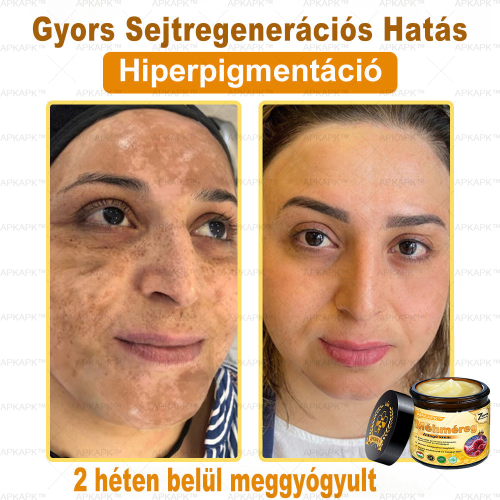 𝐀𝐏𝐊𝐀𝐏𝐊® 𝐌É𝐇𝐌É𝐑𝐄𝐆 Á𝐓𝐅𝐎𝐆Ó 𝐊𝐑É𝐌🥇𝐀 𝐛ö𝐫𝐩𝐫𝐨𝐛𝐥é𝐦á𝐤 𝐤𝐞𝐳𝐞𝐥é𝐬𝐞 𝐦𝐚𝐠á𝐛𝐚𝐧 𝐟𝐨𝐠𝐥𝐚𝐥𝐣𝐚: é𝐥𝐞𝐭𝐤𝐨𝐫𝐢 𝐟𝐨𝐥𝐭𝐨𝐤, 𝐡𝐞𝐠𝐞𝐤, 𝐬𝐳𝐞𝐦ö𝐥𝐜𝐬ö𝐤, 𝐛ö𝐫𝐧ö𝐯𝐞𝐝é𝐤𝐞𝐤, 𝐭á𝐥𝐲𝐨𝐠𝐨𝐤, 𝐩𝐚𝐭𝐭𝐚𝐧á𝐬𝐨𝐤, 𝐞𝐤𝐜é𝐦𝐚, 𝐩𝐬𝐨𝐫𝐢𝐚𝐬𝐢𝐬, 𝐚𝐜𝐧𝐞 𝐢𝐧𝐯𝐞𝐫𝐬𝐚, 𝐫á𝐧𝐜𝐨𝐤, 𝐛ö𝐫ö𝐫𝐞𝐠𝐞𝐝é𝐬 é𝐬 𝐞𝐠𝐲é𝐛 𝐩𝐫𝐨𝐛𝐥é𝐦á𝐤🔥
